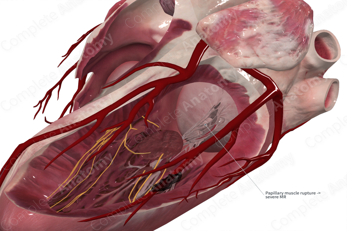 Chordae Tendineae of Left Atrioventricular Valve