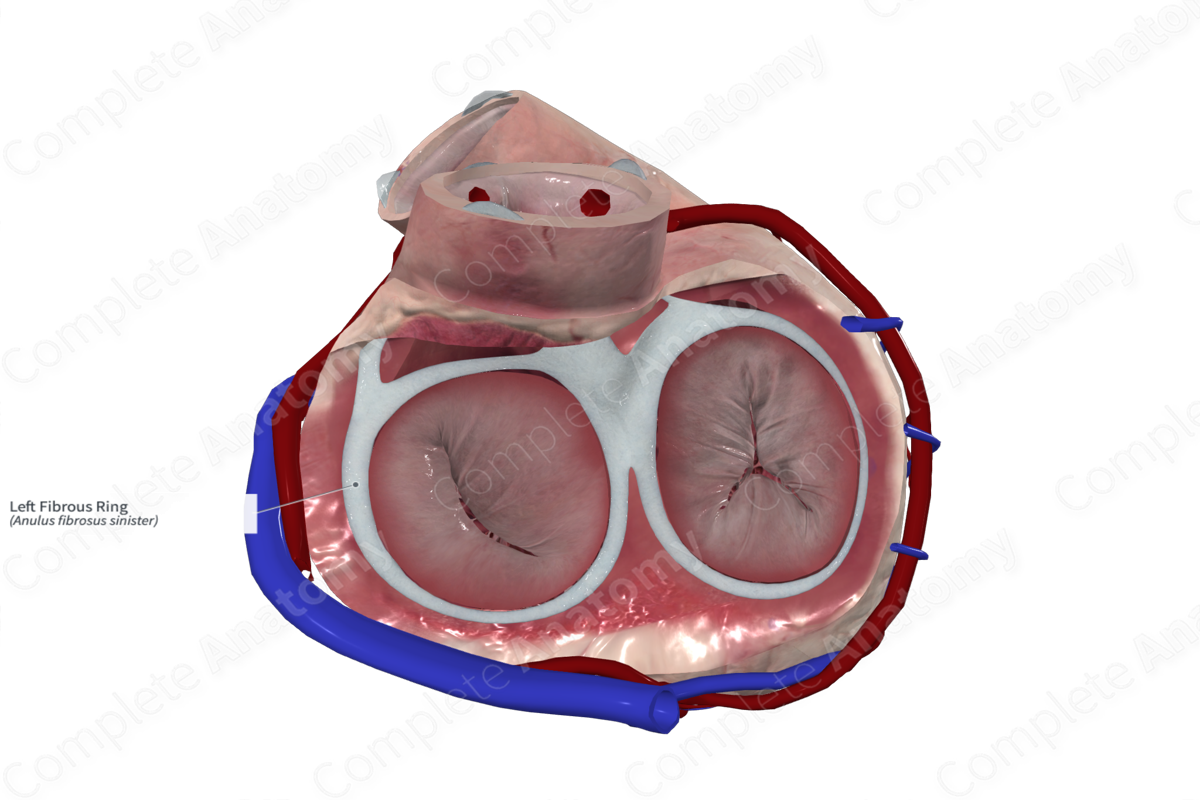 Chordal replacement and annuloplasty in one transfemoral device for  degenerative mitral regurgitation | EuroIntervention