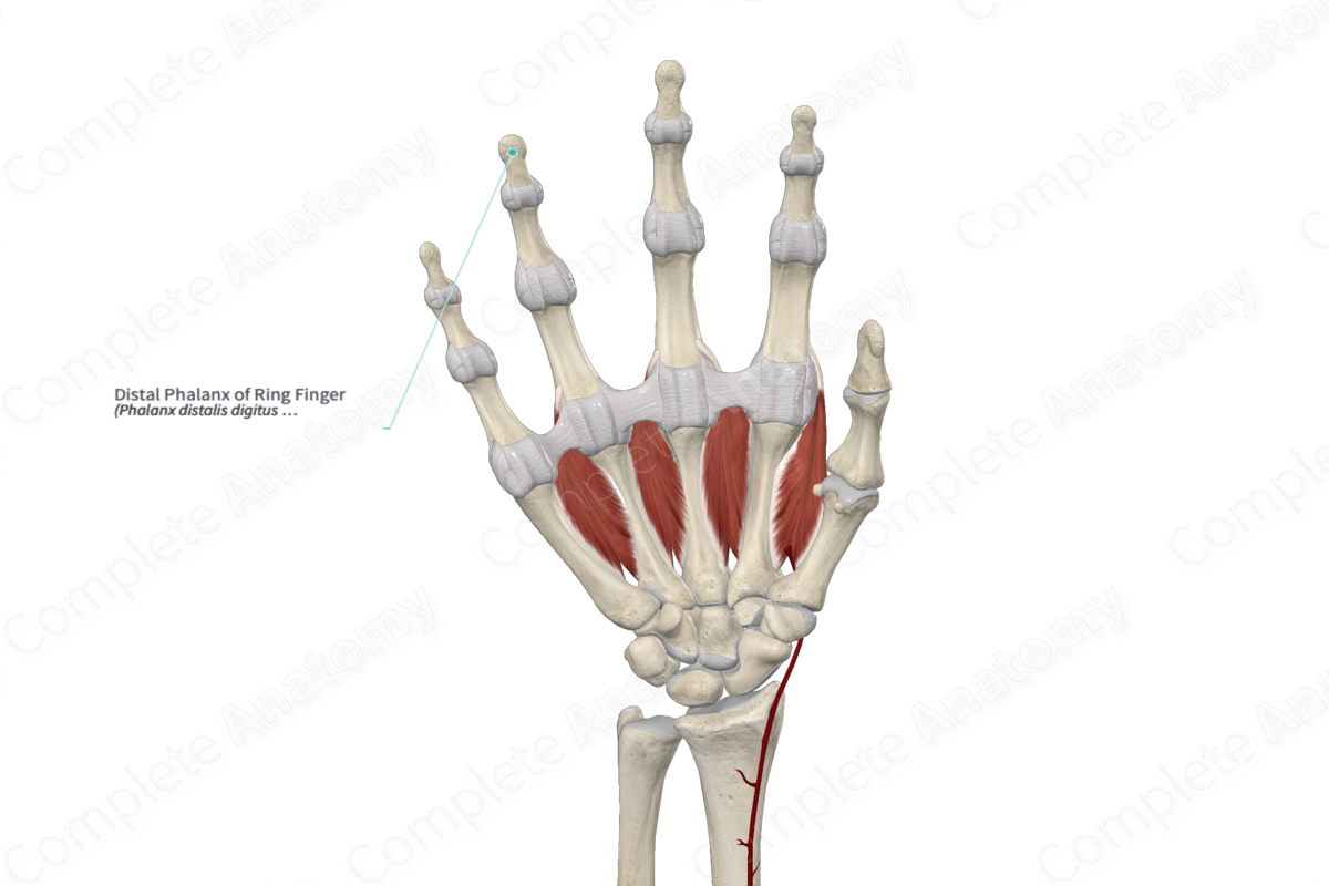 Hand Xray Shows Distal Phalanx Of Ring Finger Fracture Stock Photo -  Download Image Now - iStock