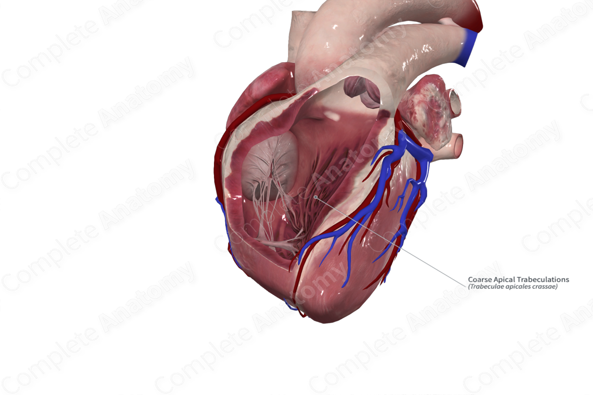 Coarse Apical Trabeculations