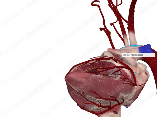 Left Coronary Leaflet