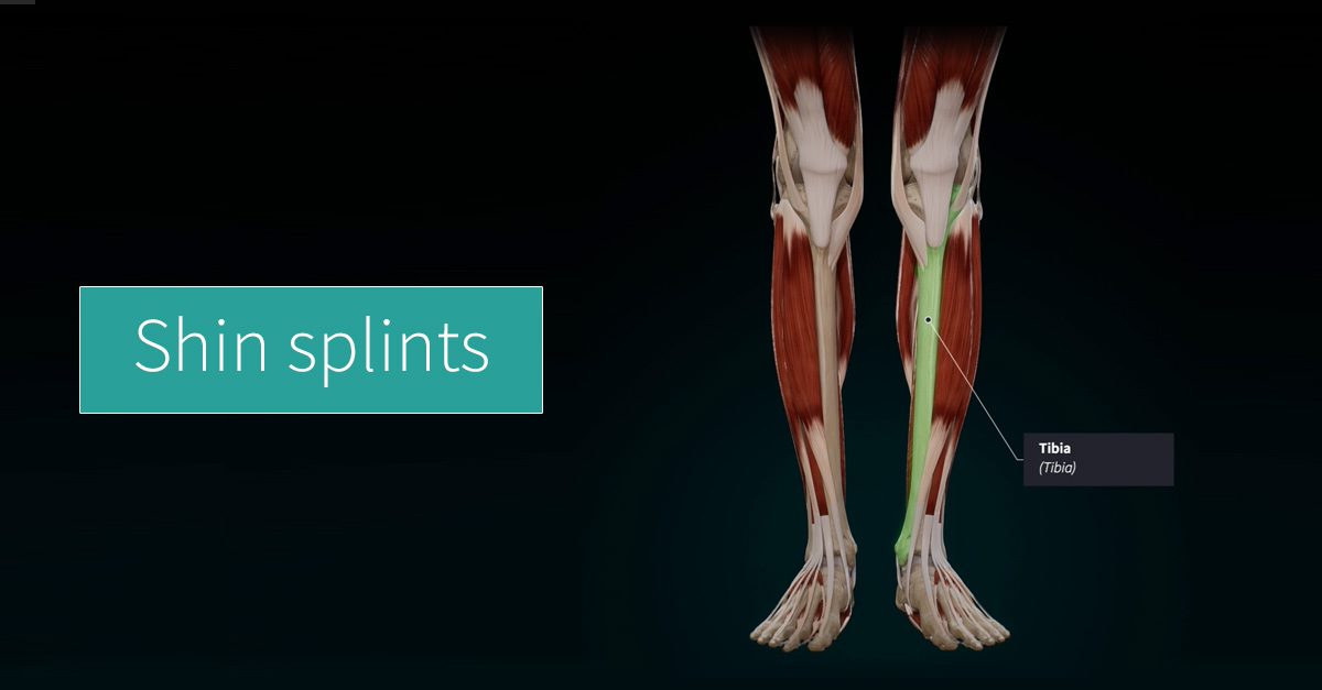 Shin splints