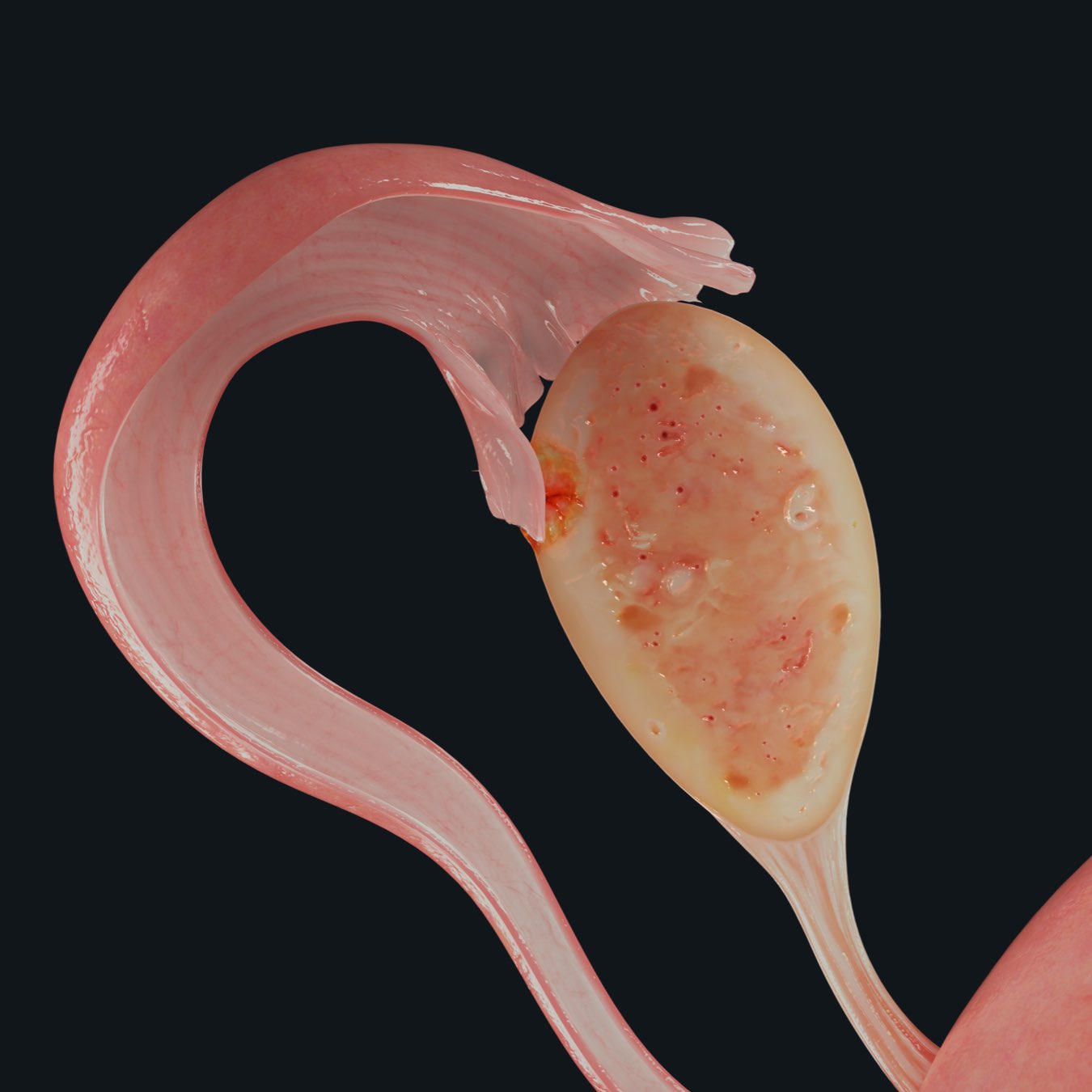 The uterus, part of the female pelvic prosection in Complete Anatomy