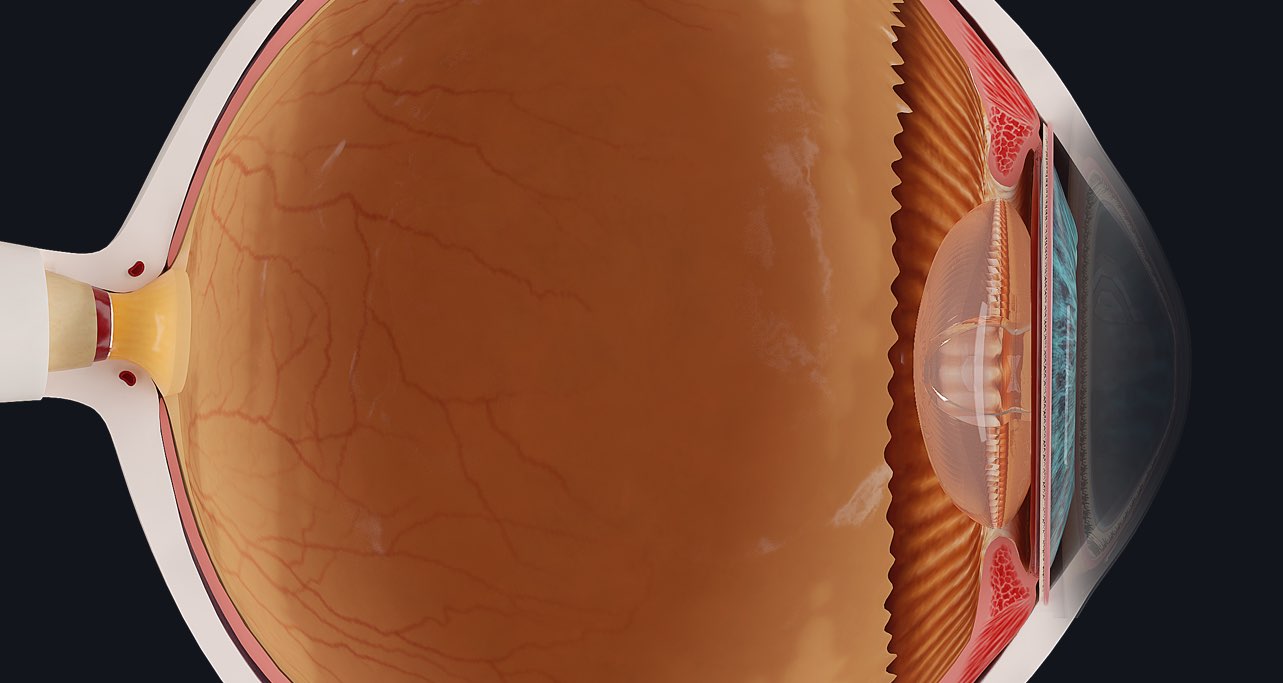 Refractive errors of the eye