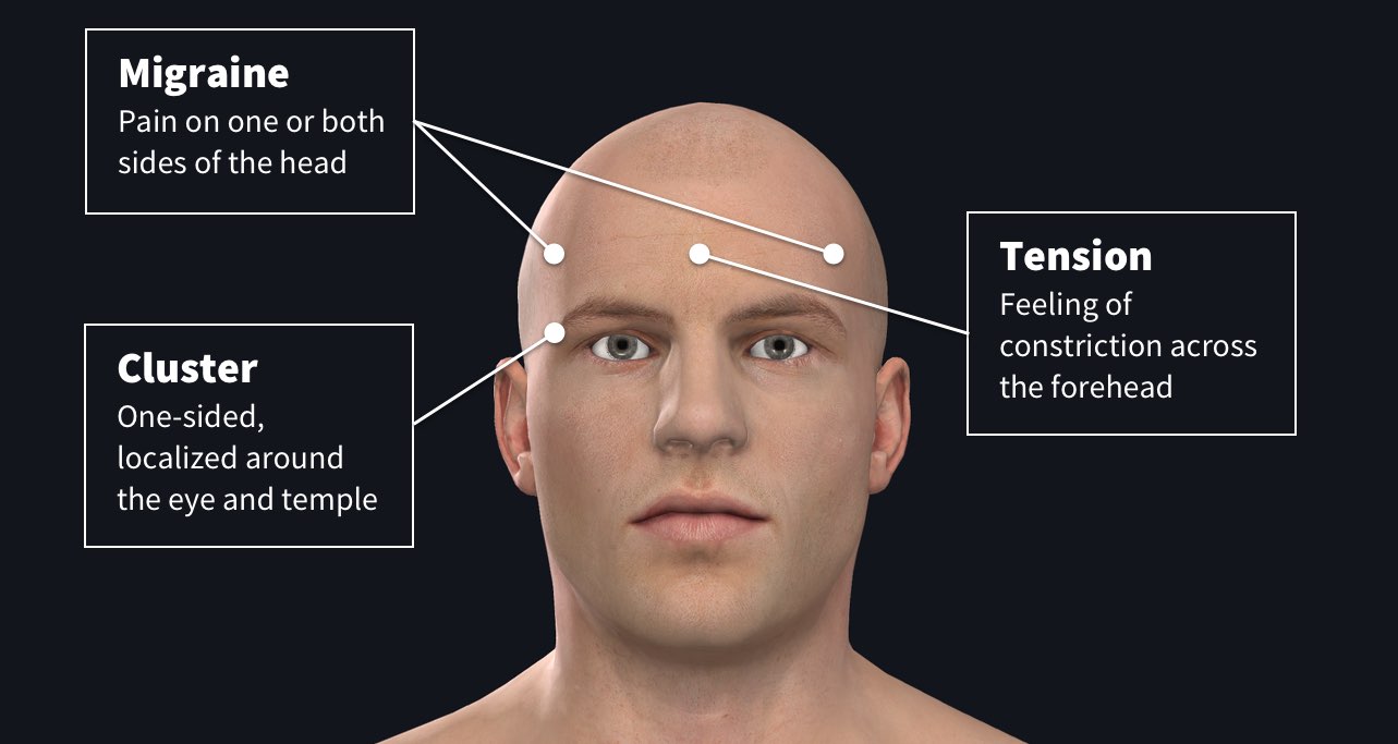 cluster headaches diagram