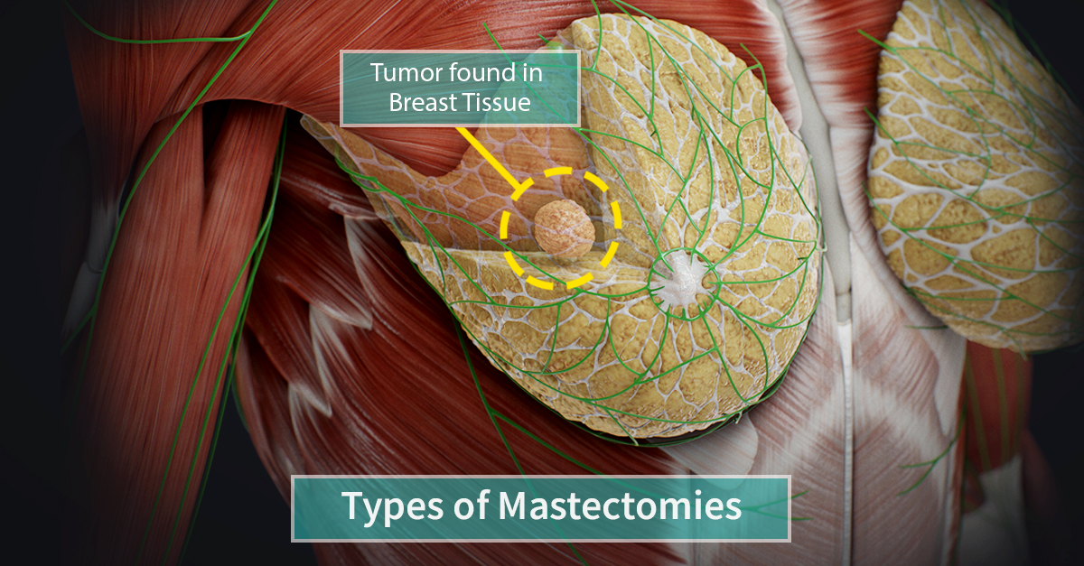 Types of Mastectomy