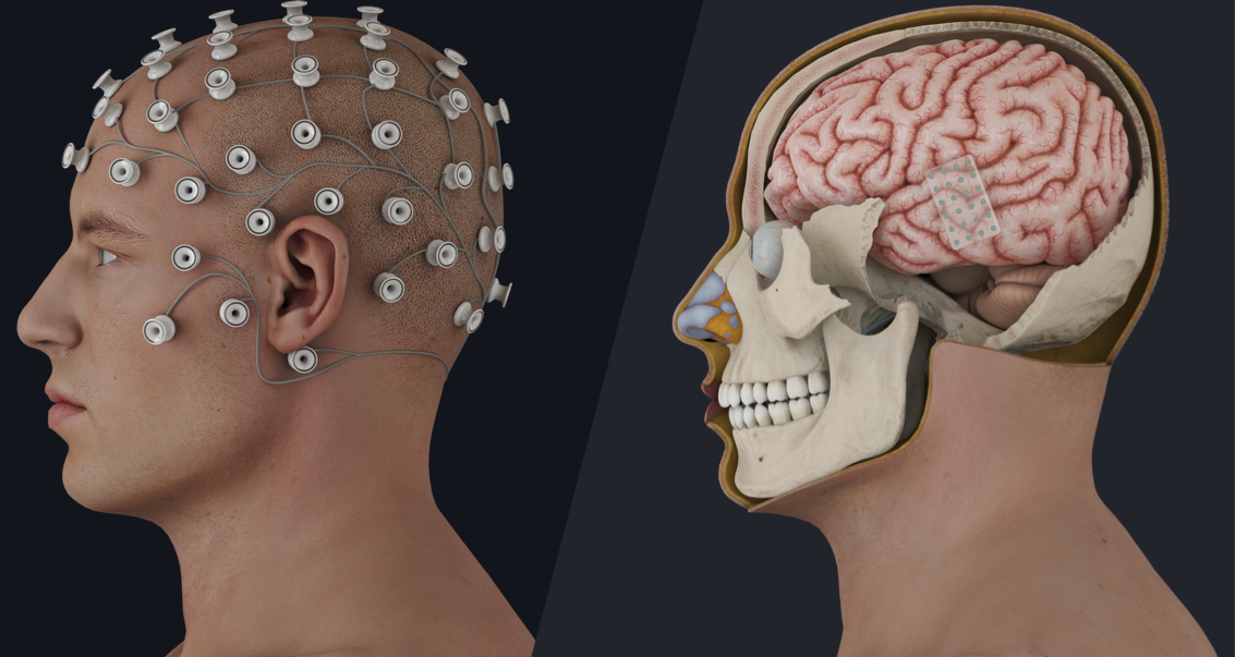 A brain computer interface showing the BCI on the skull and the BCI on the brain
