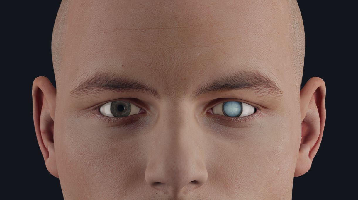 A cataract in the left eye of a male model