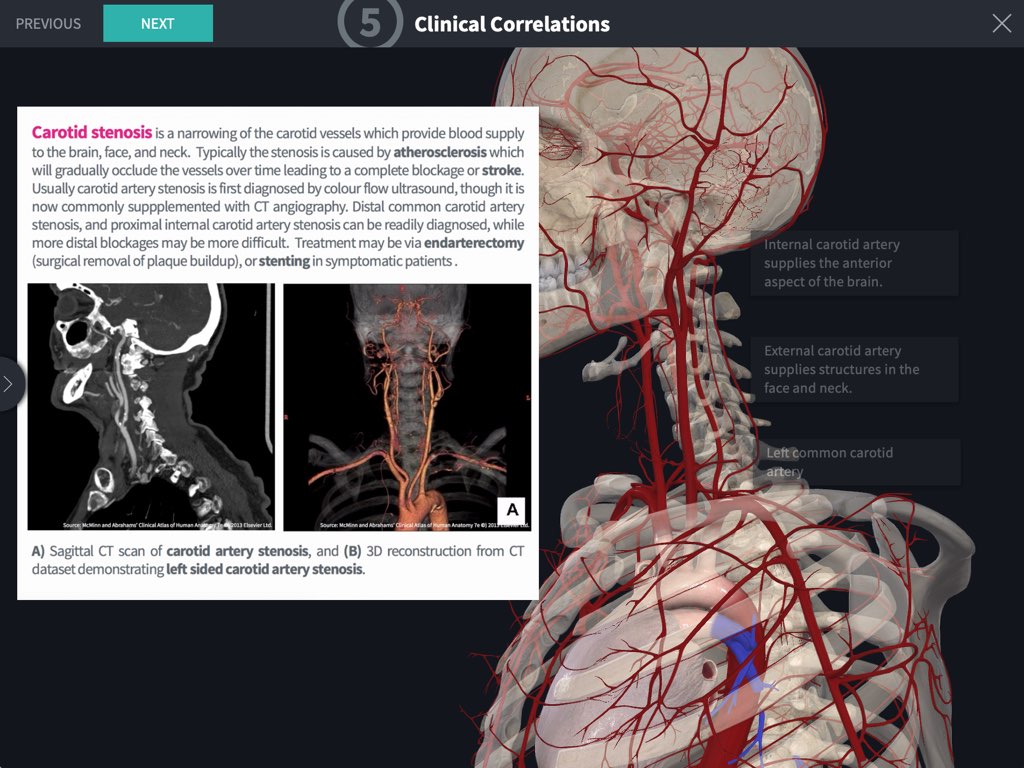 Mandibular Nerve  Complete Anatomy